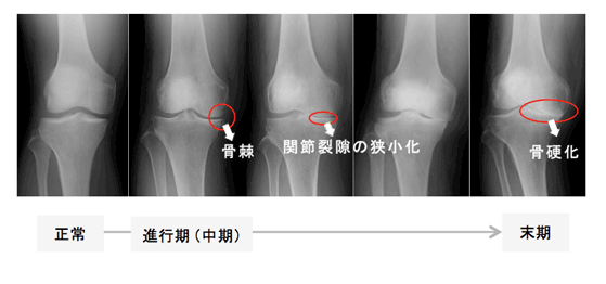 ひざの痛みをがまんし続けるのはもったいない 診察とレントゲン検査で見るポイント 現場レポート 骨と関節が痛い方をサポートするwebサイト 関節ライフ