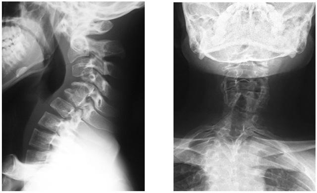 くび 腰 手足の痛み しびれは背骨の病気や神経の障害が疑われます 現場レポート 骨と関節が痛い方をサポートするwebサイト 関節ライフ