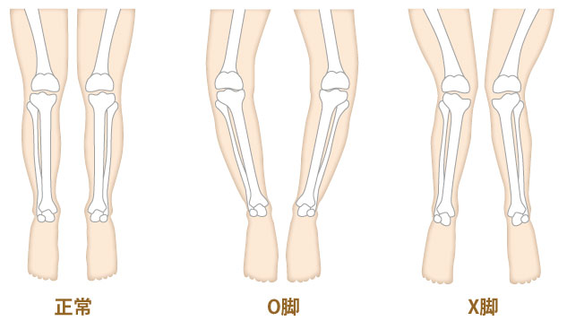 左から　　正常　O脚　X脚