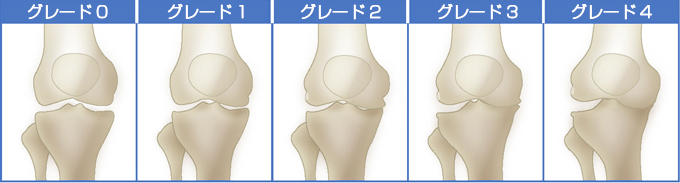 変形性膝関節症5段階