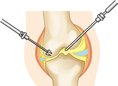 関節鏡視下手術