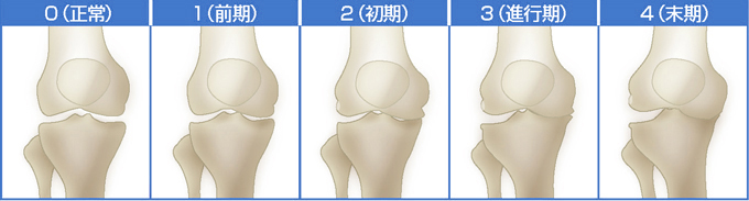 変形性膝関節症の5段階