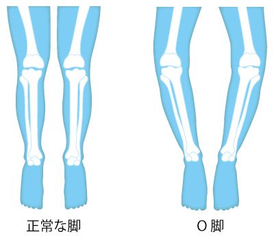 正常な脚とO脚