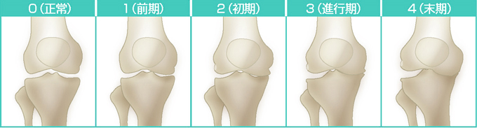 変形性膝関節症5段階