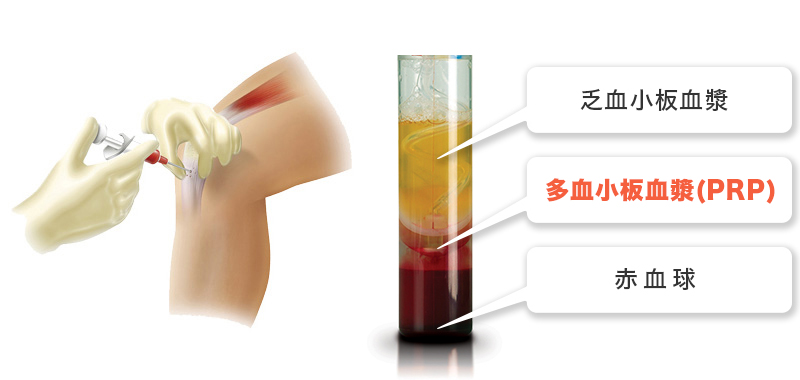 PRP（多血小板血漿）療法イメージ