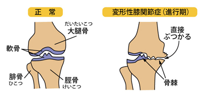 変形性膝関節症の