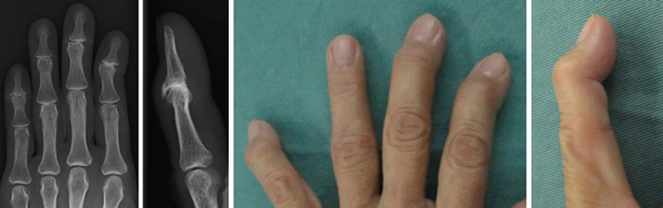 手指の変形性関節症に大きく影響する女性ホルモン エストロゲン の減少 手や指が痛い 曲がらない 手指関節の治療と期待されるaps療法 整形外科の再生医療ガイド 関節ライフ
