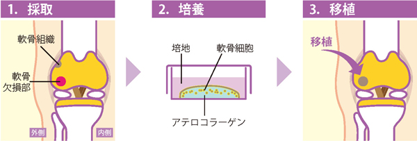 自家培養軟骨移植術