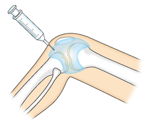 関節内注射
