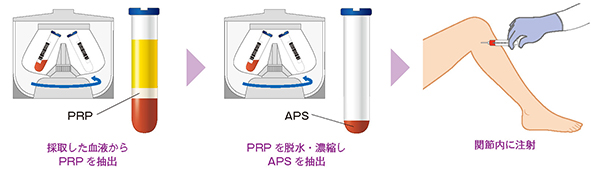 APS療法の流れ