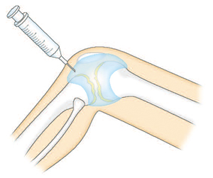 ヒアルロン酸の関節内注射