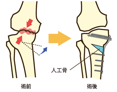 組骨切り