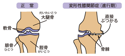 正常な膝と変形性膝関節症（進行期）