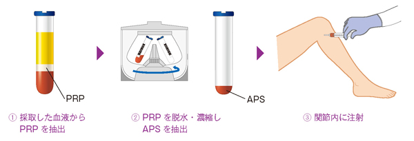 APS療法の流れ