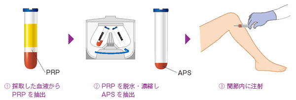 APS療法の流れ