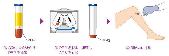 APS療法の流れ