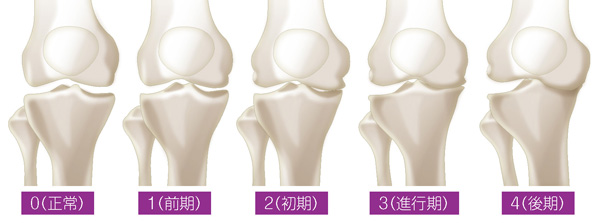 変形性膝関節症5段階