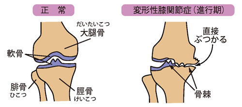 正常な状態と変形性膝関節症（進行期）