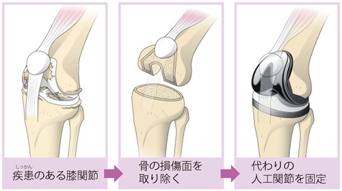 人工膝関節置換術の流れ