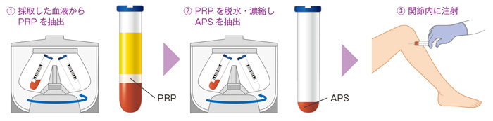 APS治療の流れ