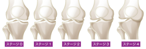 変形性膝関節症5段階