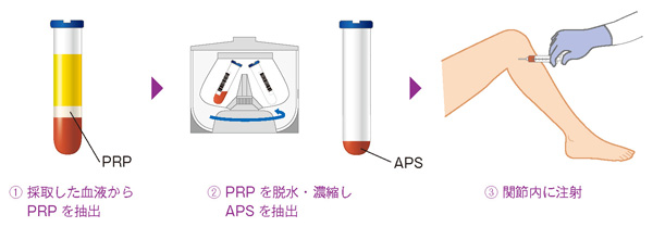 APS療法の流れ