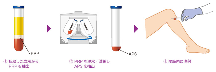 APS療法の流れ