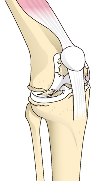 変形性膝関節症