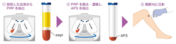 APS療法の流れ