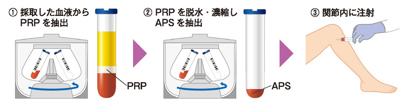 APS療法