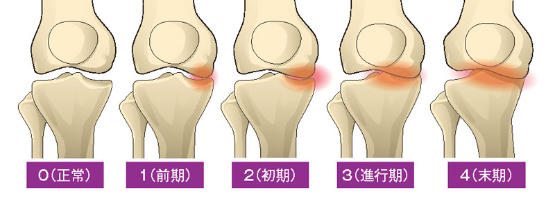 変形性膝関節症5段階