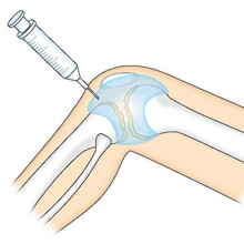 ヒアルロン酸の関節内注射