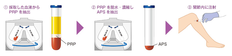 APS療法の流れ