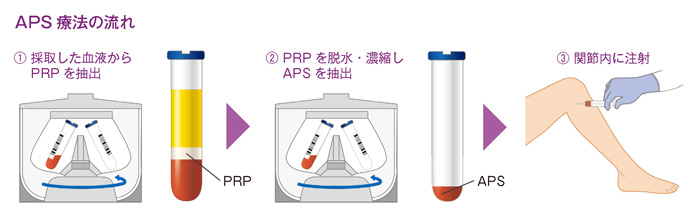 APS 療法の流れ