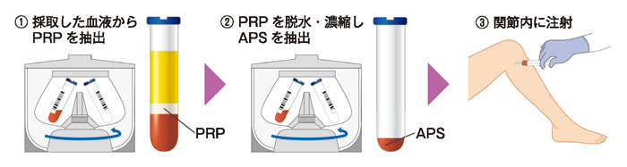 APS療法の流れ