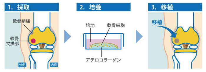 自家培養軟骨移植術