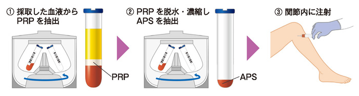 APS療法の流れ