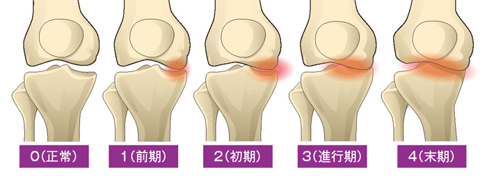 変形性膝関節症5段階