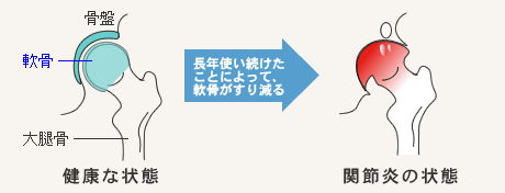 股関節のしくみや関節炎について 骨と関節が痛い方をサポートするwebサイト 関節ライフ