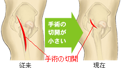 手術前後のＯ脚の改善