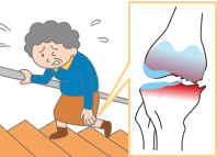 変形性膝関節症：進行期