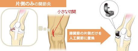 部分置換術