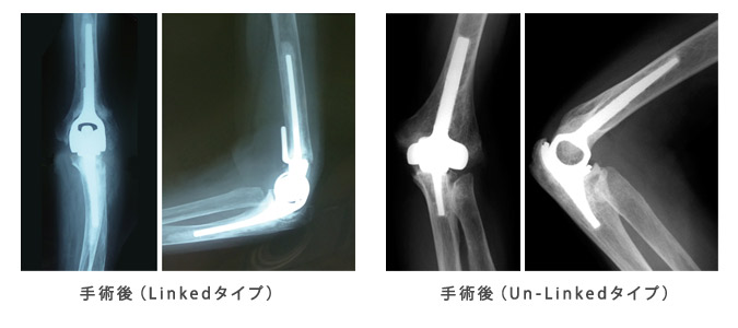 人工関節を知りたい 肩 肘 の痛みを解消したい 骨と関節の痛みにお悩みの方をサポートするwebサイト 関節ライフ